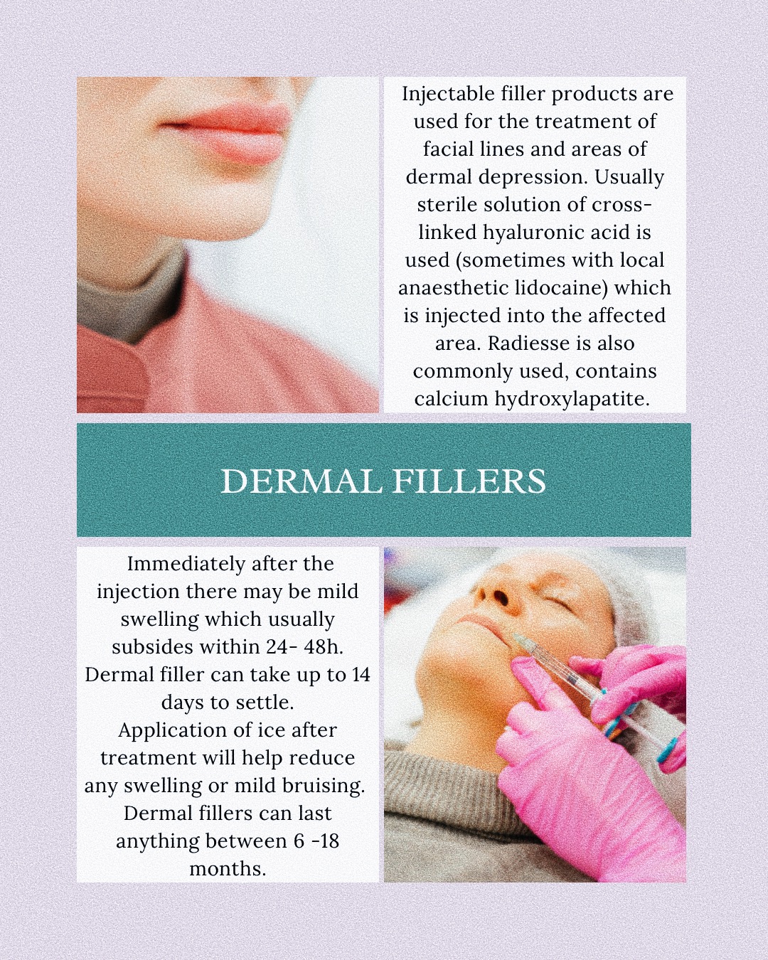 About Dermal Fillers.