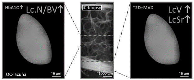 Microvascular disease associates with larger osteocyte lacunae in cortical bone in type 2 diabetes mellitus