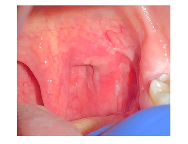 Fig.1 : L&eacute;sion &eacute;rosive &agrave; la jonction voile du palais et p&ocirc;le sup&eacute;rieur de l&rsquo;amygdale gauche de 15 mm de grand axe