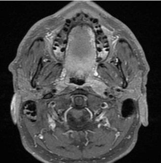 Fig.2 : IRM oropharyng&eacute;e avec injection de gadolinium montrant une ad&eacute;nopathie parapharyng&eacute;e gauche. Sur d&rsquo;autres coupes a &eacute;t&eacute; observ&eacute;e une asym&eacute;trie du voile du palais &agrave; pr&eacute;dominance gauche