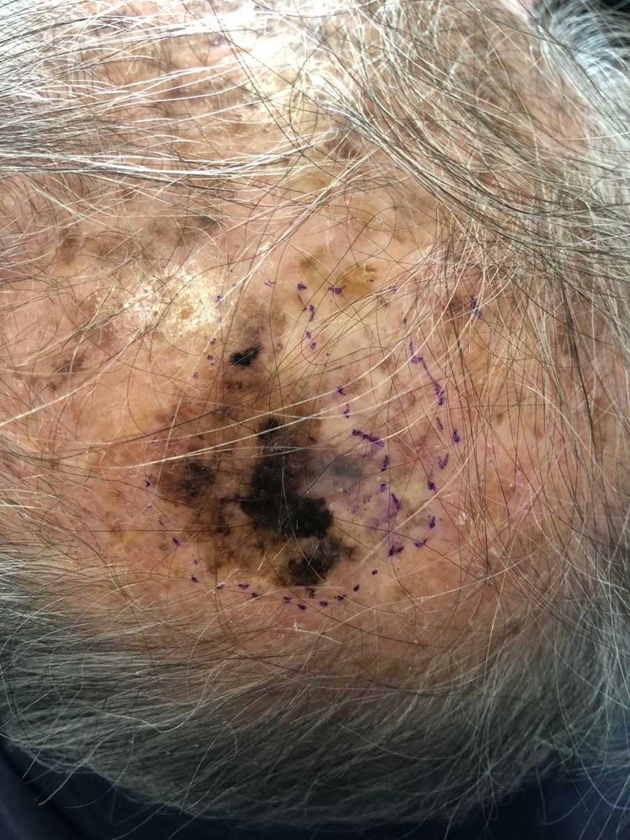 <span style="color: #333399;">La palpation cervicale r&eacute;v&egrave;le deux ad&eacute;nopathies non fix&eacute;es, non inflammatoires, de 2 cm chacune, localis&eacute;es en IIB et IIA gauche</span>