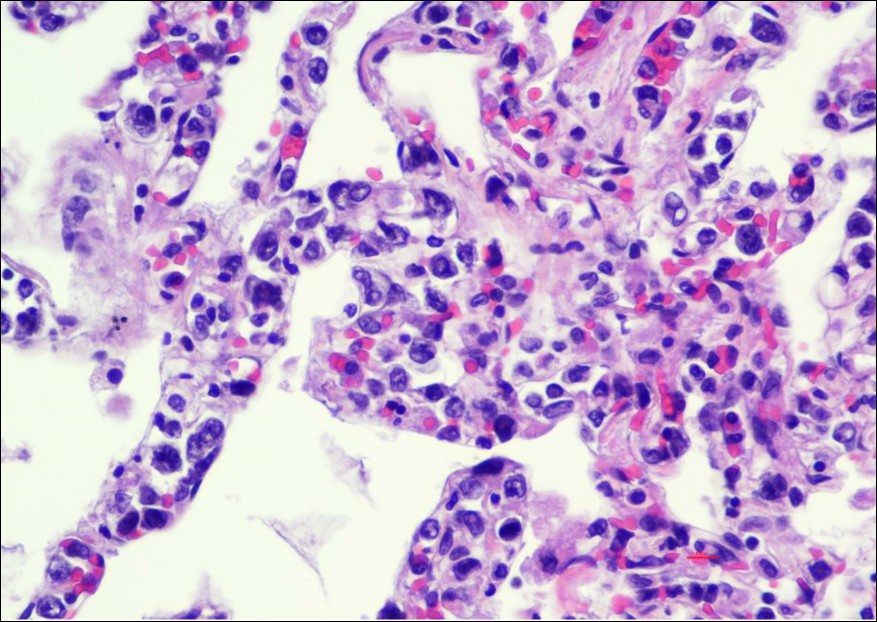 High-power view of lung parenchyma, H&E 400x