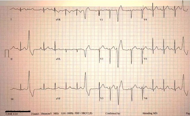 Figure 1: Athlete's ECG