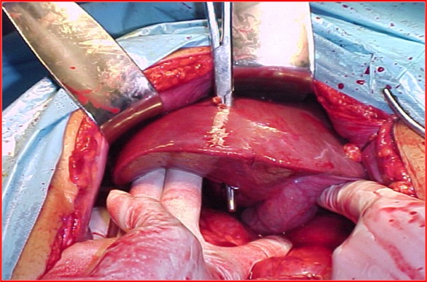 Trauma Hepático penetrante por arma de fuego. Imagen (5)