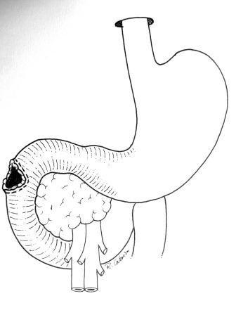La siguiente imagen (3) corresponde a paciente que ingresa a urgencias con trauma penetrante abdominal por proyectil de arma de fuego, en epigastrio, hemodin&aacute;micamente INESTABLE.