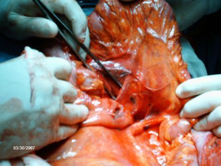 La siguiente imagen (4) corresponde a una lesi&oacute;n de 3 cm. en el Angulo de Treitz (asa delgada), sin lesi&oacute;n de meso.