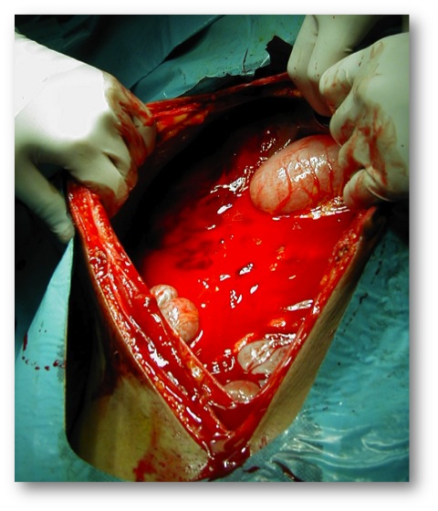 Paciente masculino de 30 a&ntilde;os de edad que ingresa a urgencias 30 min. posterior a herida por arma de fuego por proyectiles m&uacute;ltiples (escopeta) en hipocondrio derecho, INESTABLE (Shock grado IV). Es llevado a mesa operatoria, al abordar la cavidad abdominal se evidencia la siguiente imagen: