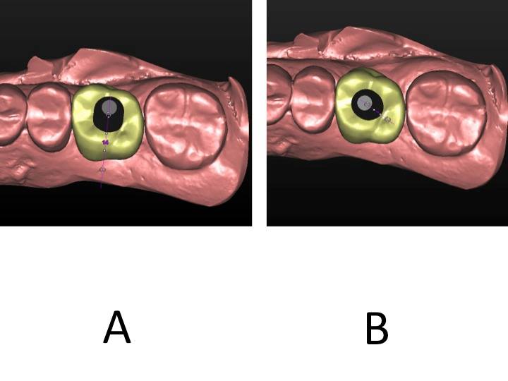 Occlusal view with virtual tooth